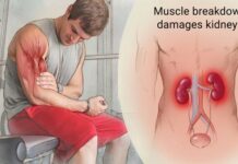 SY Performance Monthly Muscle Flex – Know the Warning Signs of Rhabdomyolysis